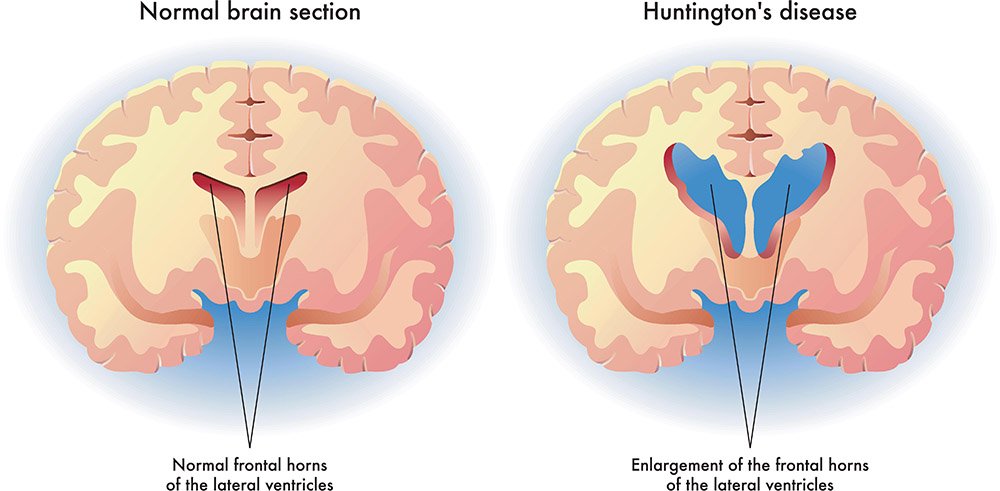 Huntington's disease - symptoms, treatments and causes | healthdirect