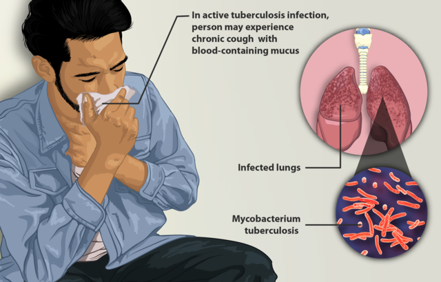 Tuberculosis (TB) 