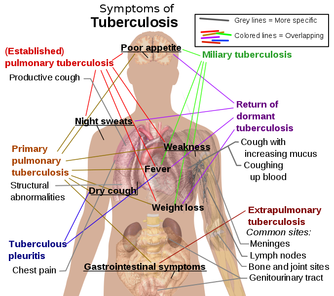 Common symptoms of tuberculosis 