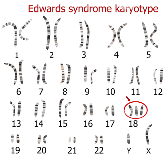 Edwards Syndrome