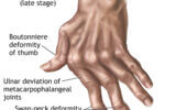 Rheumatoid Arthritis