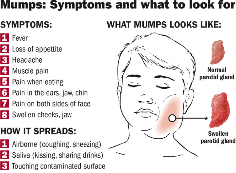 Mumps - PMF IAS