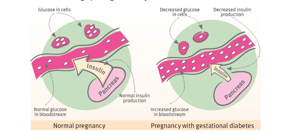 Gestational Diabetes - PMF IAS
