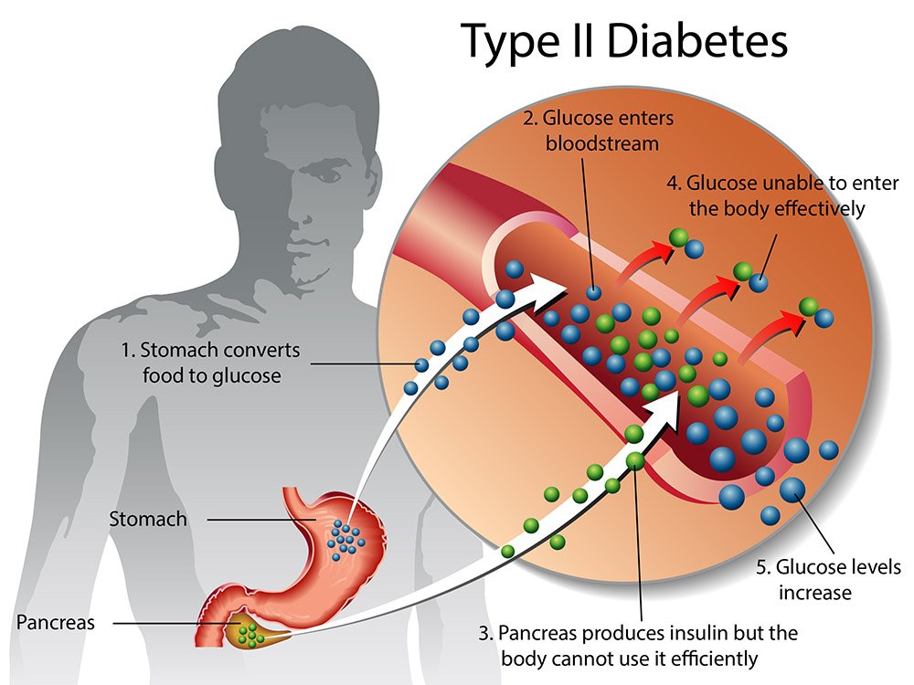 Type 2 diabetes: symptoms, causes and treatment - PMF IAS