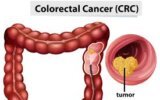 Colorectal cancer (CRC)