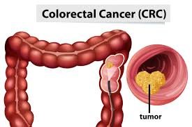 Colorectal cancer (CRC)