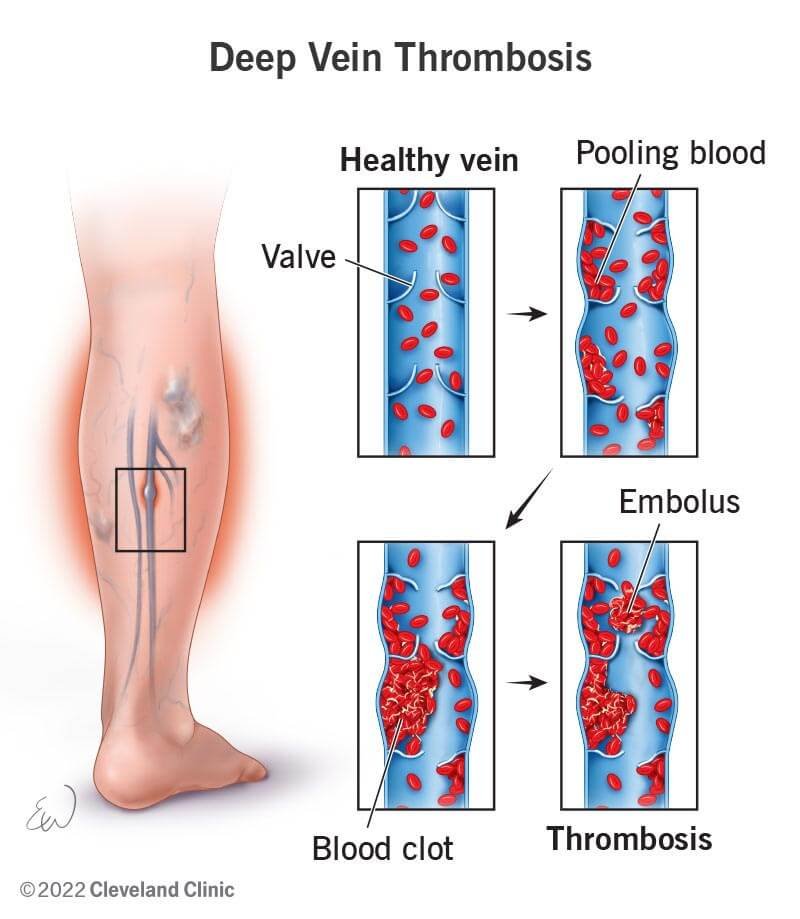 Thrombosis - PMF IAS