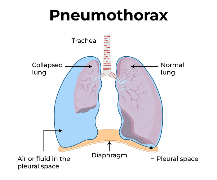 Pneumothorax - PMF IAS