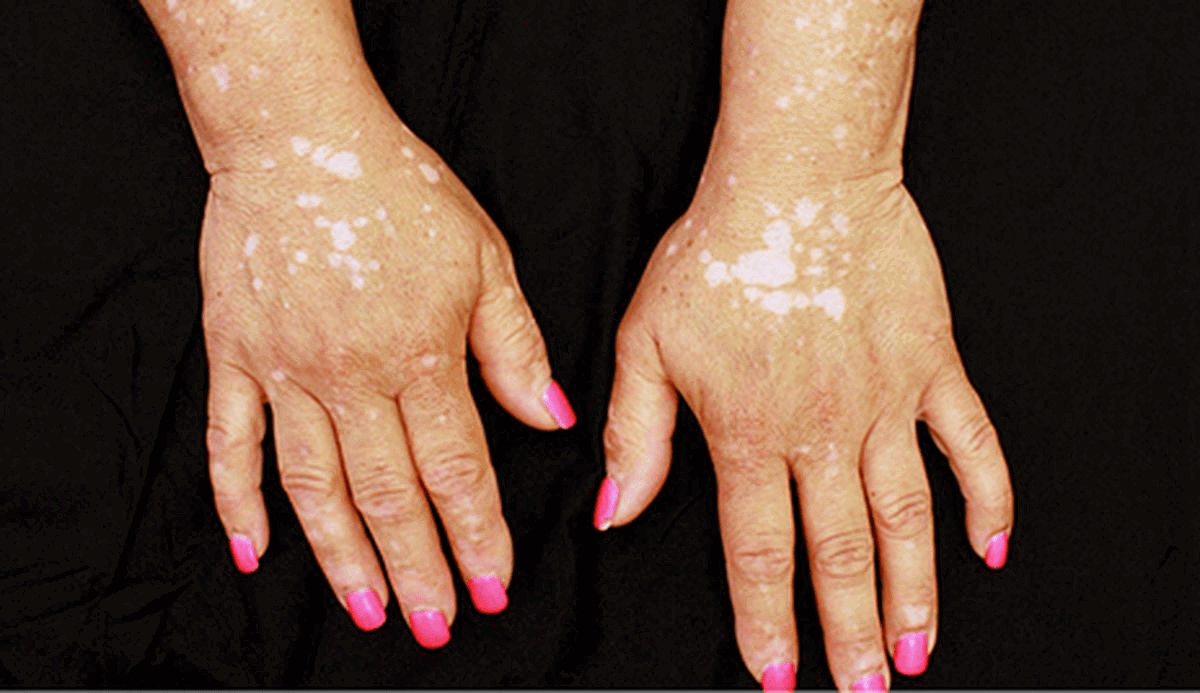 Vitiligo